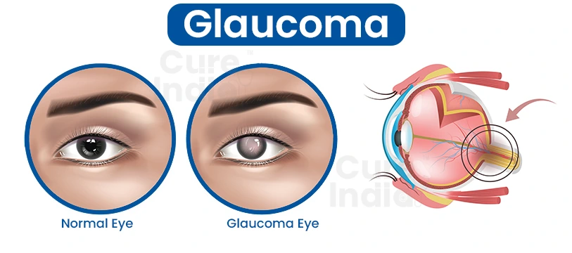 what is glaucoma
